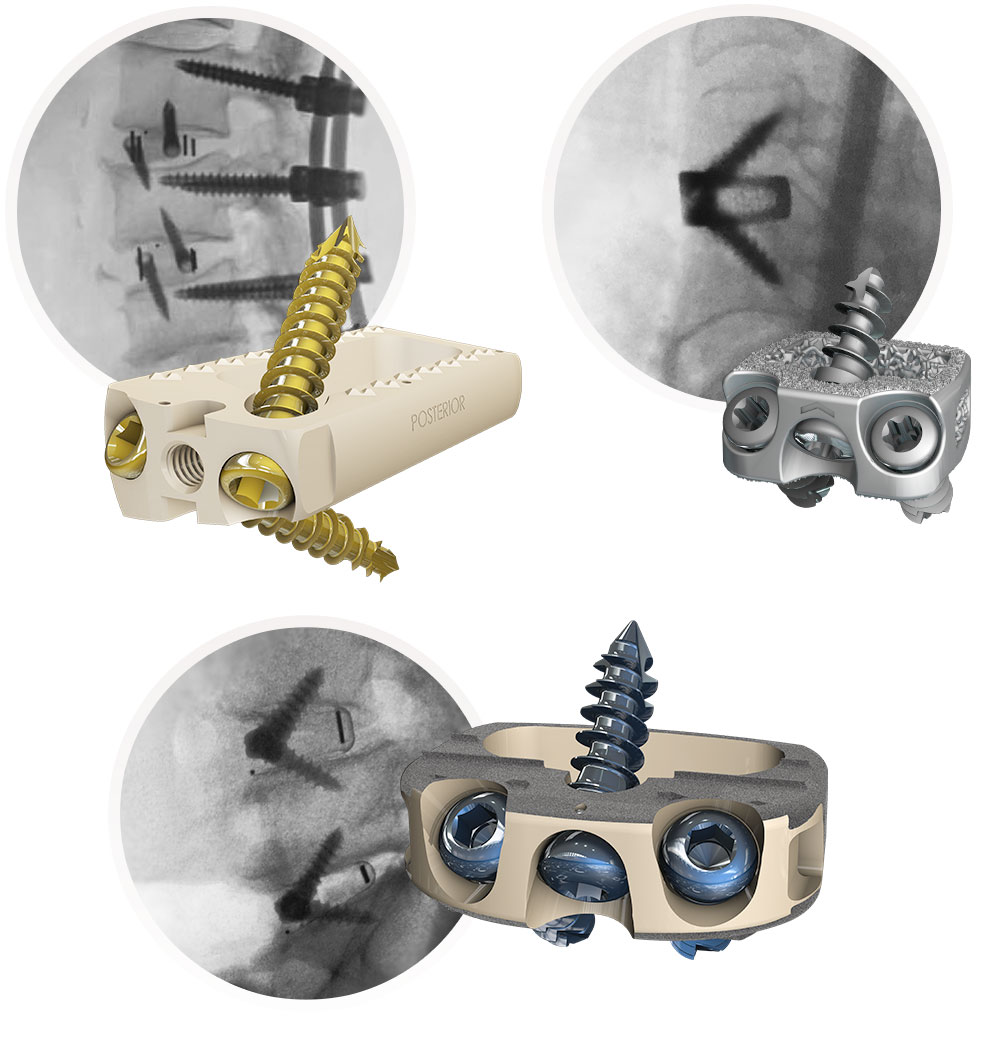 spinal fusion devices