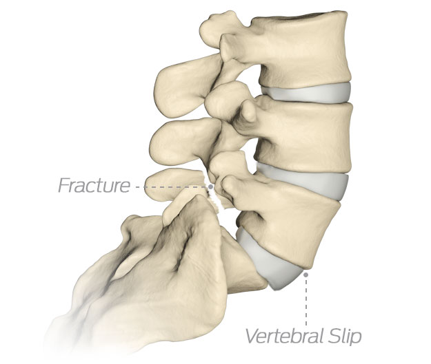 vertebral slip
